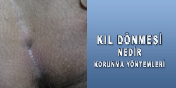 kil-donmesi-nedir-korunma-yontemleri