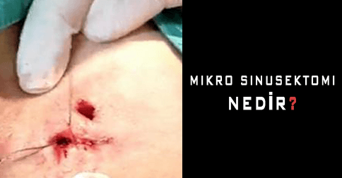 mikro-sinusektomi-nedir